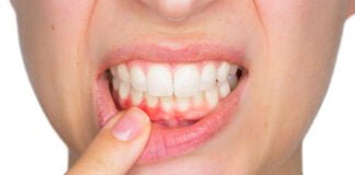 Enfermedades periodontales