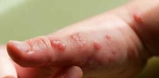 viruela del mono Perú casos