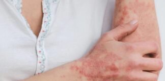 viruela del mono Perú