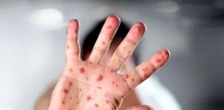 viruela del mono perú