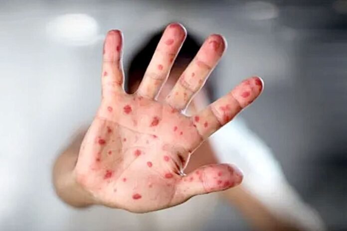 viruela del mono perú viruela del mono perú