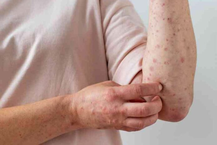 viruela del mono viruela del mono casos perú