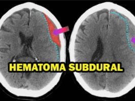 hematoma subdural qué es